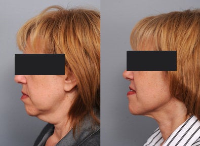 Smartlipo Neck Lift - This patient complained about the wrinkles and crinkles of her neck. She was disturbed by the hanging tissue and lack of facial definition. Smartlipo of the neck and a little Radiesse to the face helped to make a tremendous improvement without major surgery.