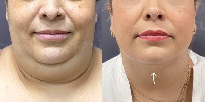 55-64 year old woman treated with AirSculpt - This patient received Chin AirSculpt+ which is fat removal and skin tightening in the chin jowl region. These results are 1 month post-op and final results will show around 6 months post-op. Procedure was done in our Boston office.