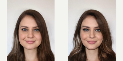 25-34 year old woman treated with Lip Repositioning - Bichectomy procedure provides more defined facial contour along with thinner cheeks.