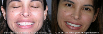 Gummy Smile Correction - 
	This patient did not like the shape, shade, or length of her teeth. She had a reverse smile line. We lengthened the upper front teeth, changed the shape, and widened the arch. Porcelain laminates (veneers) and crowns were used. The patient now has a beautiful, more feminine smile.