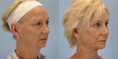 55-64 year old woman treated with Facelift - This 59 year old patient was treated with Facelift.