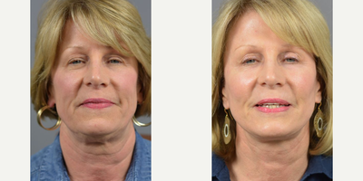 Woman treated with Eyelid Surgery - These results from a recent facelift, blepharoplasty with fat repositioning case performed by facial specialists, Dr. James C. Marotta.