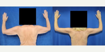 Post-Weight-Loss Full-Body Contouring Transformation - Our patient is a 61-year-old White female who had previously been morbidly obese and reached a highest weight of 265 lbs. Through dieting, exercise, RNY gastric bypass, and GLP-1 medications, she reached her lowest weight of 165 lbs. After this tremendous weight-loss journey, she came to Dr. Katzen to remove excess skin and reshape her body contour. She was placed under general anesthesia for a customized full-body transformation plan. Dr. Katzen performed a circumferential lower body lift to remove loose skin and tissue from the abdomen, waist, hips, lower back, buttocks, and outer thighs. This 360 body lift helped improve hanging tummy skin, lower body laxity, and waistline shape. He also performed a brachioplasty, also known as an arm lift, to remove hanging upper arm skin and create a smoother arm contour. To address loose upper torso skin, Dr. Katzen performed a torsoplasty with vertical incisions on both sides of her torso, removing excess skin from the back and sides to improve her upper body shape. As part of the same transformation, fat was grafted from other areas of her body, prepared, and transferred to her buttocks to improve buttock contour, projection, and balance. This fat transfer to the buttocks, also known as a Brazilian Butt Lift, helped refine her shape using her own tissue. Photos were taken 3 months after surgery, and our patient achieved remarkable results with a smoother, more balanced figure.