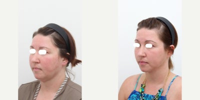 35-44 year old woman treated with AccuLift, Liposuction, Laser Liposuction - Chief Complain: Bulky cheeks, face always looks swelled, face assymetry, double chin, chubby cheeksTreatment Plan: face liposuction (double chin, cheek bone, cheeks)Outcome: face shape balance, reduce exessive fat, more V-lined shape
