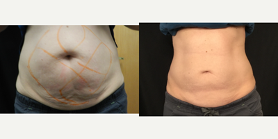 55-64 year old woman treated with Emsculpt, CoolSculpting Elite - 56 year old woman treated with NeoEmsculpt of 1 series (package of 6) followed by 1 week apart. CoolSculpting Elite was also done with 2 cycles on the abdomen which resulted in 2 inches lost.