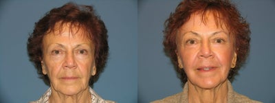 Naturalfill, Lower lid Bleph, Full face Co2 Laser - 	1 month post Naturalfill, Lower Lid bleph and co2 laser.