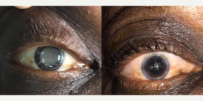 Patient treated with Cataract Surgery - We performed cataract surgery using Alcon toric IOL to this patient who came from Congo Republic. Cataract is leading cause of blindness in African cauntries.
