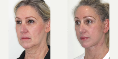 Woman treated with Deep Plane Facelift, Neck Lift - More Deep Plane Face and Necklift results:Deep Plane Face and Necklifts have become the procedure of choice for facial rejuvenation.I have been performing this surgery for more than 12 years and understand the nuances.This is a follow-up to the last 2 posts and shows the Front before and after fade at only 2 weeks after Deep plane Face and Necklift and Browlift.No Makeup!My patient who had previous Revision Rhinoplasty with me had noticed signs of ageing including loose skin and soft tissue around her mouth, along her jawline (jowls) and her neck.Now at 2 weeks postop:Note the improved jawline and neck contour. There is no redundant neck tissue. Also, note the refreshed upper face appearance.Deep Plane Face and Neck lifts are natural-looking because the patient's own ligaments are retensioned and repositioned. Deep Plane Face and Neck lifts are ideal for younger or older patients.