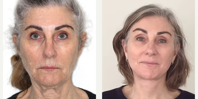 Woman treated with Deep Plane Facelift, Neck Lift - More Deep Plane Face and Necklift results:Deep Plane Face and Necklifts have become the procedure of choice for facial rejuvenation.I have been performing this surgery for more than 13 years and understand the nuances.My patient had noticed signs of aging including loose skin and soft tissue around her mouth, along her jawline (jowls) and her neck.Now at 3 weeks postop:Note the improved jawline and neck contour. There is no redundant neck tissue. Also, note the refreshed upper face appearance.Deep Plane Face and Neck lifts are natural-looking because the patient's own ligaments are re-tensioned and repositioned. Deep Plane Face and Neck lifts are ideal for younger or older patients.