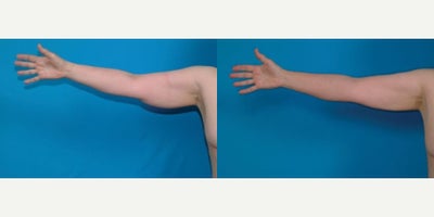 55-64 year old woman treated with Liposuction - Procedure: Liposuction of lower body, arms and axillae.