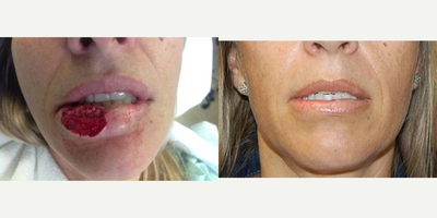 35-44 year old woman treated with Lip Surgery - 41y.o. with squamous cell carcinoma of lower lip. 1 year after Mohs excision and reconstruction with mucosal advancement flap. 1 month after second stage reconstruction with tissue rearrangement and autologous fat grafting.