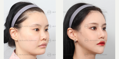 25-34 year old woman treated with Genioplasty, Jaw Reduction, V Line Surgery, Rhinoplasty, Cheekbone Reduction - Mandible Jaw Reduction, Genioplasty, Zygoma Reduction, Rhinoplasty (Nose Ridge+Nose Tip+Short Nose Correction+Weir Reduction+Donated Rib Cartilage (use at nose tip))