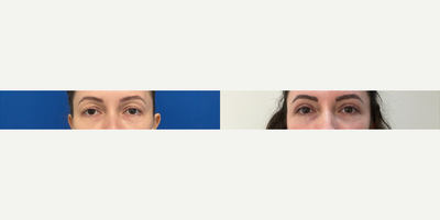 45-54 year old woman treated with Eyelid Surgery, Double Eyelid Surgery - Bilateral upper and lower eyelid blepharoplasty. Quad blepharoplasty.