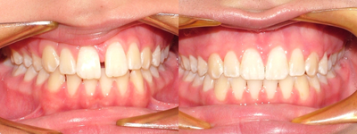 Upper space closure on a teenage patient - 
	Maxillary diastemma (mid-line space) closure in a teenage patient using the Damon philosophy
