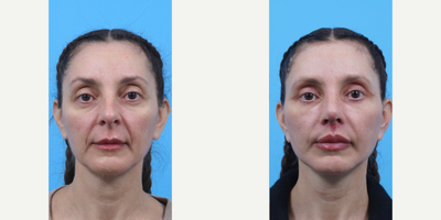 Woman treated with Eyelid Surgery, Facelift, Lip Lift, Lip Implants, Rhinoplasty, Neck Lift - Woman treated with Eyelid Surgery, Facelift, Lip Lift, Lip Implants, Rhinoplasty, Neck Lift