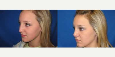 25-34 year old woman treated with Rhinoplasty - 25-34 year old woman treated with Rhinoplasty