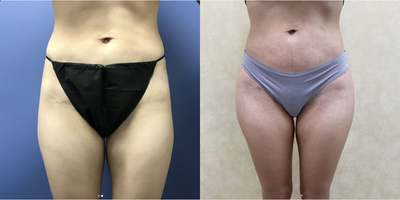 Woman treated with Hip Augmentation - Woman treated with Hip Augmentation