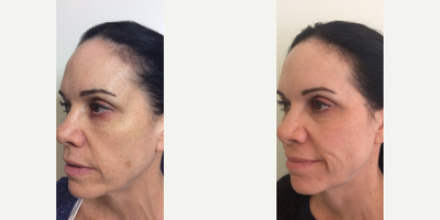Fraxel Laser Dark Spots - The Fraxel Laser improved the appearance of the patient's aging, sun-damaged, and scarred skin. The Fraxel Laser can be used in all areas of the face, neck, hands, and body to reduce brown discoloration, scars, and wrinkles without the painful or lengthy recovery.