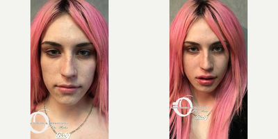Woman treated with Lip Augmentation - Woman treated with Lip Augmentation