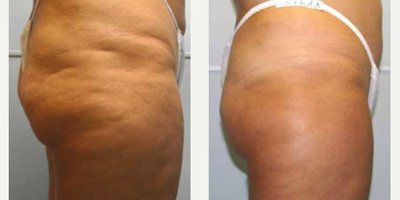 JuVaShape - Photo provided courtesy of Alma Lasers, Ltd., performed by Dr. Emilia del Pino and Dr. Ramon Rosado