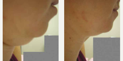 JuVaShape - Photo provided courtesy of Alma Lasers, Ltd., performed by Dr. Rafael Nunes