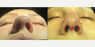 Woman treated with Rhinoplasty - This gorgeous patient came to me from Arizona after a motor vehicle accident fractured her nose, leaving her with a crooked and raised dorsum.I performed dorsal inversion and straightened her bridge with osteotomies and a left spreader graft.However, her tip cartilages are tricky. Scroll through to see the frontal pre-op picture and you can see the tip cartilages are bulbous and seem to point up along the nose rather than out towards the nostrils.This can't be softened with suture techniques or underlays. Instead, I freed the lateral crura from their attachments and reinserted them into pockets along the nostril rim.The see-through splints you can see on the sides of her nose help to keep those repositioned cartilages in place, and also reduce swelling.
