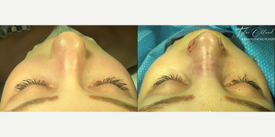 Woman treated with Rhinoplasty - This gorgeous patient came to me from Arizona after a motor vehicle accident fractured her nose, leaving her with a crooked and raised dorsum.I performed dorsal inversion and straightened her bridge with osteotomies and a left spreader graft.However, her tip cartilages are tricky. Scroll through to see the frontal pre-op picture and you can see the tip cartilages are bulbous and seem to point up along the nose rather than out towards the nostrils.This can't be softened with suture techniques or underlays. Instead, I freed the lateral crura from their attachments and reinserted them into pockets along the nostril rim.The see-through splints you can see on the sides of her nose help to keep those repositioned cartilages in place, and also reduce swelling.
