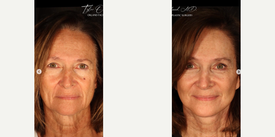 Woman treated with Deep Plane Facelift, Eyelid Surgery - Softer, refreshed, and natural...This wonderful patient trusted me with her facial rejuvenation after years of enjoying the sun. She underwent extended deep plane face and neck lift, browlift, upper and lower blepharoplasty, and fat transfer. Two months out every element of her face and neck demonstrated improvement. Best of all, she looks natural. No odd tension or windswept look.She is wearing zero makeup in both of these photos.
