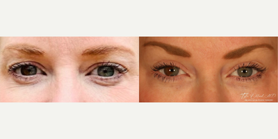 Woman treated with Brow Lift - She was bothered by excess skin around the eyes, which made them appear darker than they truly were, masking this incredible genetic trait.I demonstrated to her that she actually didn't have excess skin on the upper lid; it was the brow, which had fallen with time, causing the upper lid skin to bunch and hood.I performed a browlift to reset the structure of her periorbital region, which eliminated the redundant skin. I also did a fat transfer (as well as a facelift/neck lift) to the under eyes to eliminate her tear troughs and rejuvenate the skin.Notice the shape of her eyes, the brightness, the amount of upper lid show, and the youthful arch of her brow...This procedure is performed entirely through small incisions in the hairline, with no visible scars. And while her forehead and brow still animate (move), the deep creases are softened.She is two months out and her result is stunning.
