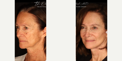 Woman treated with Deep Plane Facelift, Eyelid Surgery - Softer, refreshed, and natural...This wonderful patient trusted me with her facial rejuvenation after years of enjoying the sun. She underwent extended deep plane face and neck lift, browlift, upper and lower blepharoplasty, and fat transfer. Two months out every element of her face and neck demonstrated improvement. Best of all, she looks natural. No odd tension or windswept look.She is wearing zero makeup in both of these photos.