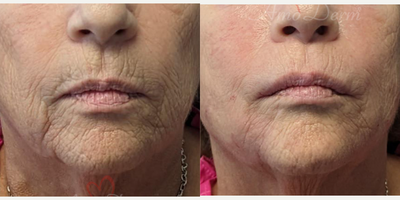 55-64 year old woman treated with Liquid Facelift, Juvederm, Restylane, Voluma, Vollure - Liquid Facelift and treatment lines around the mouth and lower cheeks with Juvederm, Radiesse, Vollure, Restylane or Bellafill injected with cannula