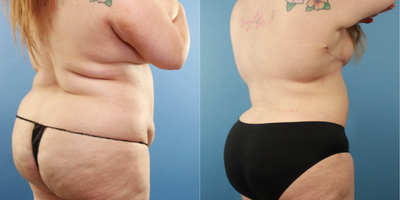 25-34 year old woman treated with Breast Lift, Tummy Tuck, Liposuction, Nipple Surgery - Patient is 3 months post 360 liposuction tummy tuck, breast lift with nipple graft. Patient is very happy with her results, stated that it was life changing.
