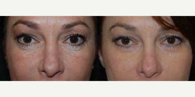 46 year old woman - CO2 Laser Resurfacing to Lower Lids (front view) - 46 year old woman desired rejuvenation of her lower lids.3 months after CO2 Laser Resurfacing of Lower Lids by Dr. Steely.