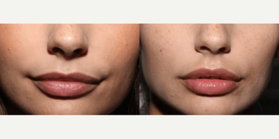 25-34 year old woman treated with Silikon 1000 - 25-34 year old woman treated with Silikon 1000