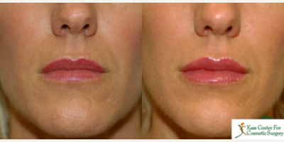 35-44 year old woman treated with Silikon 1000 - 35-44 year old woman treated with Silikon 1000