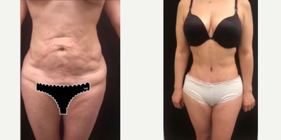 25-34 year old woman treated with Tummy Tuck, Mommy Makeover - 33 y.o female who underwent abdominoplasty which entailed removal of abdominal laxity, repair of diastasis recti, repositioning of umbilicus and liposuction of abdomen, flanks. At 2 month post-op, her contours are significantly improved.