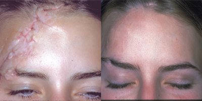 This woman had significant forehead scaring. She underwent scar revision and laser skin resurfacing - Traumatic scars can be very devastating - the injury alone is emotionally, a scar. The subsequent physical scars can be a reminder of the event. The latter can be improved with a surgical scar revision and in this case, laser skin resurfacing.