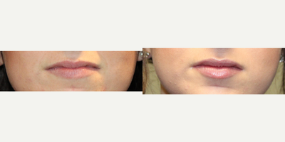 18-24 year old woman treated with Volbella - This 20 something female wanted just a bit more fullness to her lips. She was injected with Volbella. We achieved this natural result with only 1 syringe. After photo is same day as her treatment.
