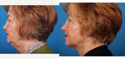 45-54 year old woman treated with Neck Lift - concerned about neck volume and excess skin. Neck lift with SMAS component