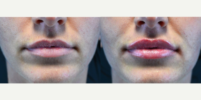 18-24 year old woman treated with Restylane Silk - 24 year old female received Restylane Silk filler in her lips