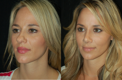 Rhinoplasty - patient underwent a rhinoplasty for correction of a large nose with a bulbous tip
