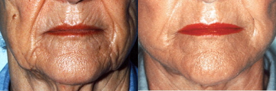 Laser, Face - 	Laser to smooth skin on face