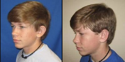 17 or under year old man treated with Ear Surgery - Standard Otoplasty with cartilage shaping
