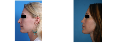 34 year female 2 years after rhinoplasty -
Patient desired a reduction in her profile. She also wanted amore delicate and feminine nose