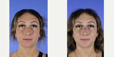 25-34 year old woman treated with Nonsurgical Nose Job, Restylane Lyft - Patient consulted about a Liquid Rhinoplasty. Patient wanted a slightly elevated tip and wanted to disguise her dorsal hump. We were able to give her a noticeable change in her profile with one syringe of Restylane Lyft.