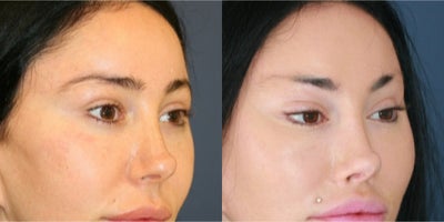 35-44 year old woman treated with Canthoplasty, Eyelid Surgery - Before and two years after Bratz blepharoplasty, Feel Beautiful Plastic Surgery
