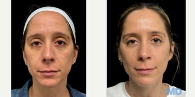 35-44 year old woman treated with NeoGen Plasma, Skin Tightening, Skin Rejuvenation - 90 days post procedure, this lovely patient is still seeing improvement with her results.