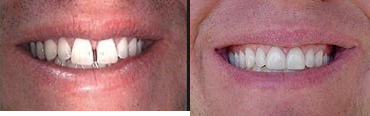 Porcelain Veneers - This this a close up of Derek's case.