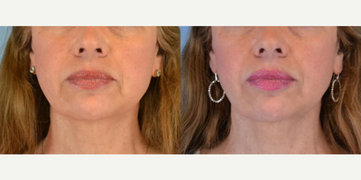 55-64 year old woman treated with ArteFill - 58 year old female received Artefill to marionette lines