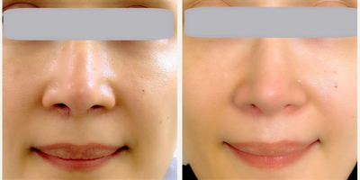 Woman treated with Rhinoplasty, Alarplasty - Alar reduction (Nostril reshaping)